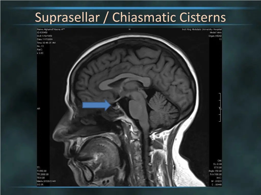 suprasellar chiasmatic cisterns 2