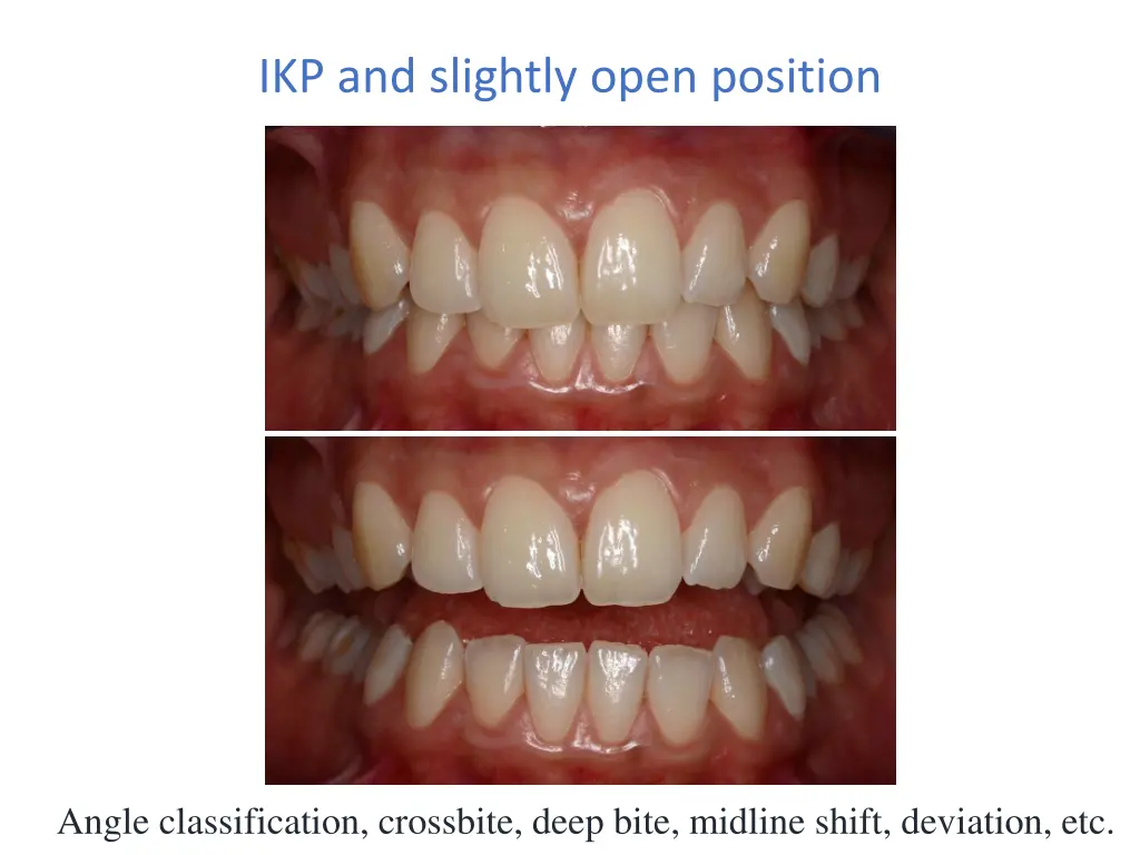 ikp and slightly open position