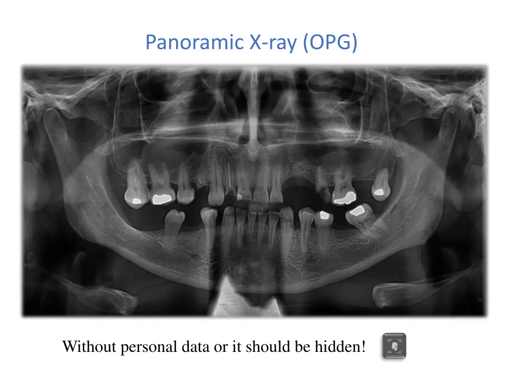 panoramic x ray opg