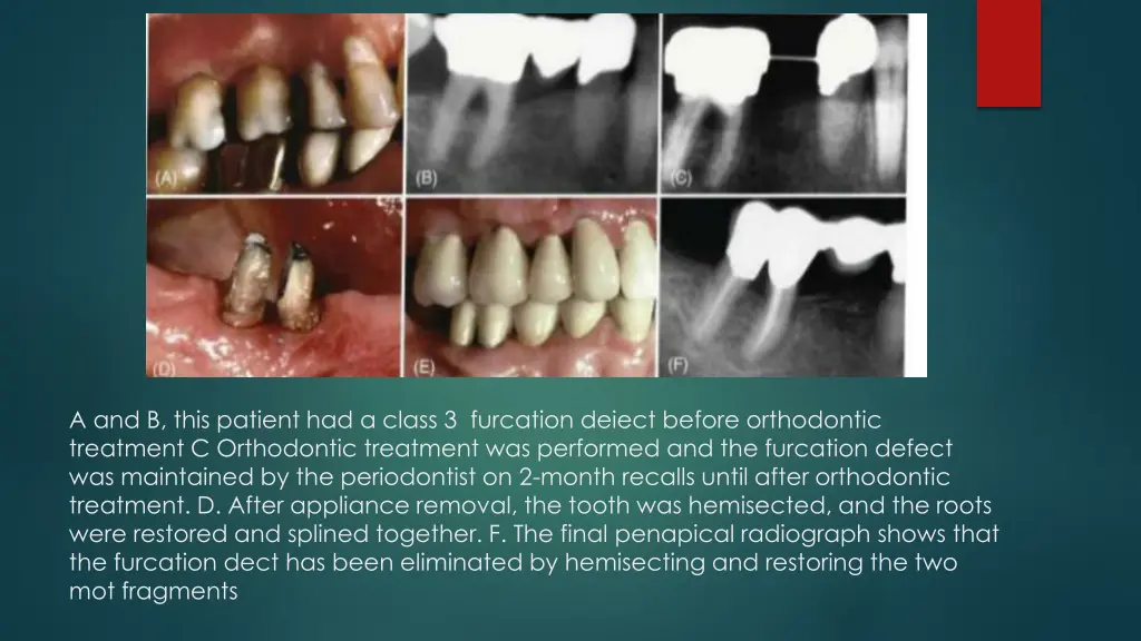 a and b this patient had a class 3 furcation