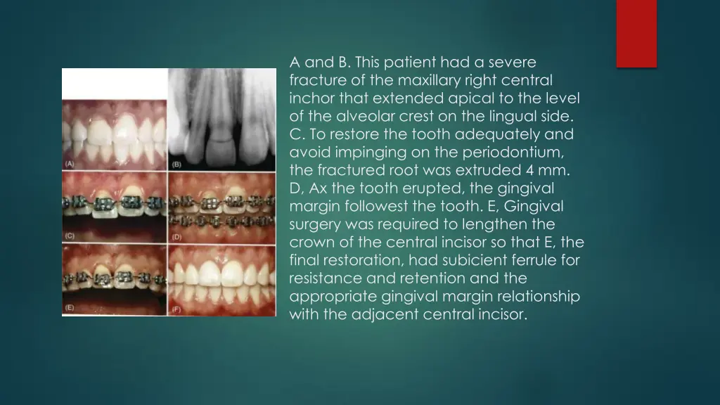 a and b this patient had a severe fracture