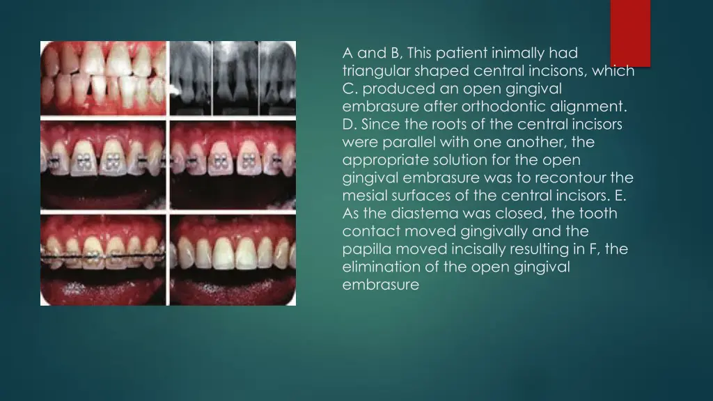 a and b this patient inimally had triangular