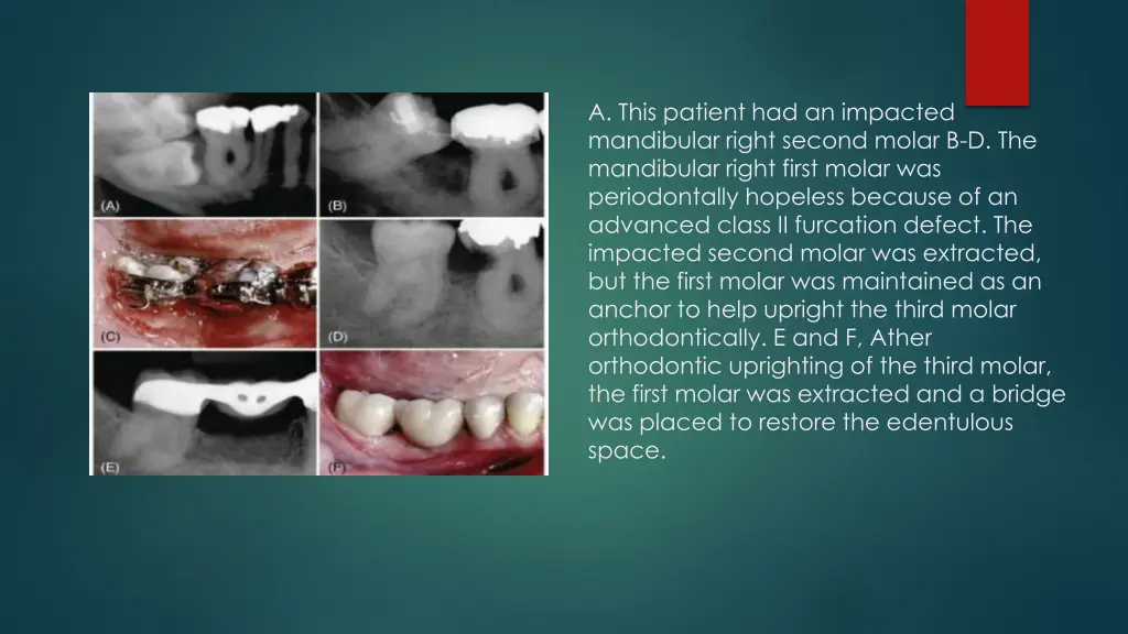 a this patient had an impacted mandibular right