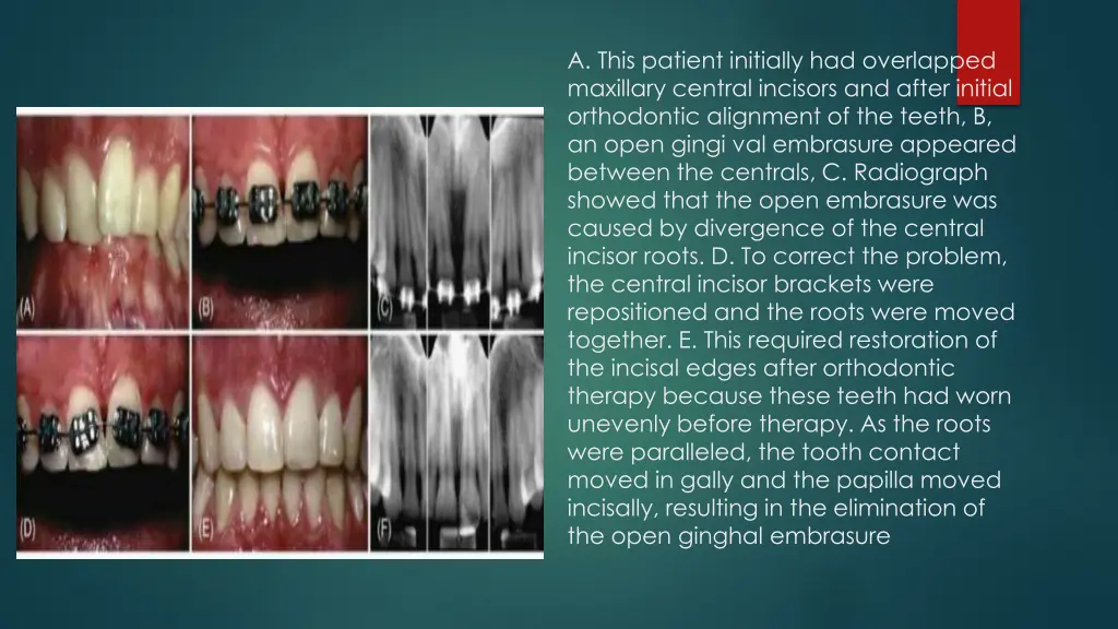 a this patient initially had overlapped maxillary