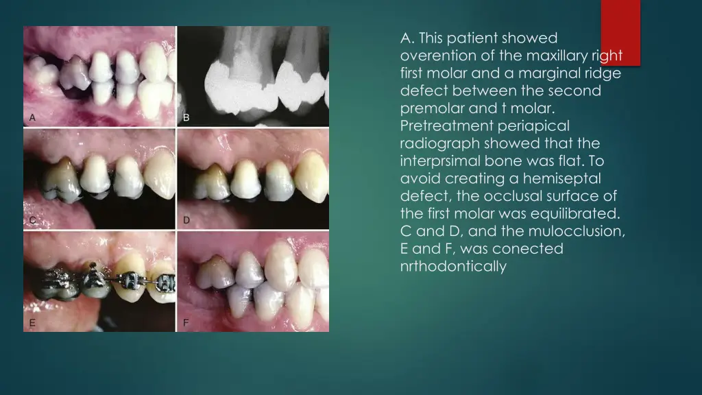 a this patient showed overention of the maxillary