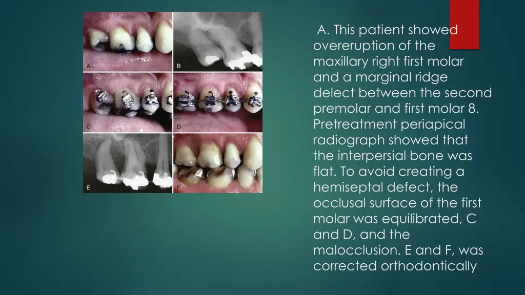 a this patient showed overeruption