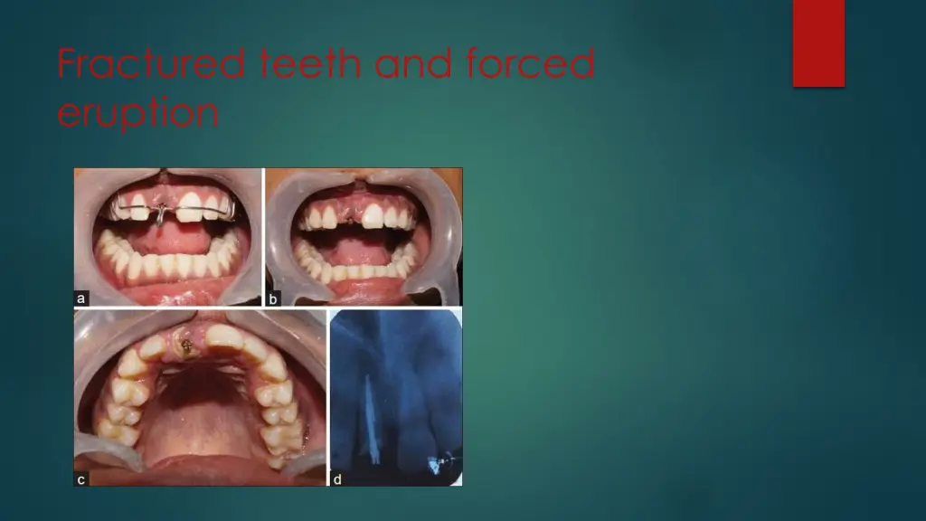 fractured teeth and forced eruption