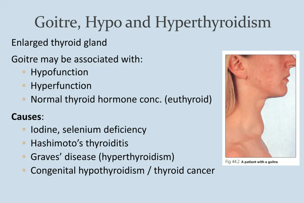 goitre hypo and hyperthyroidism