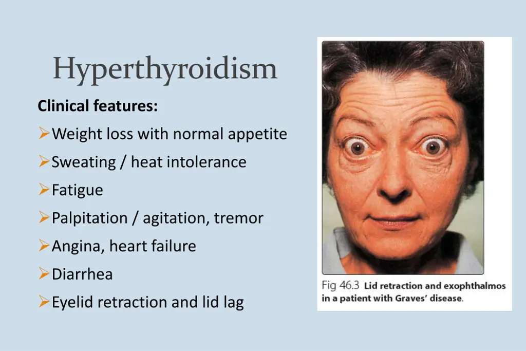 hyperthyroidism