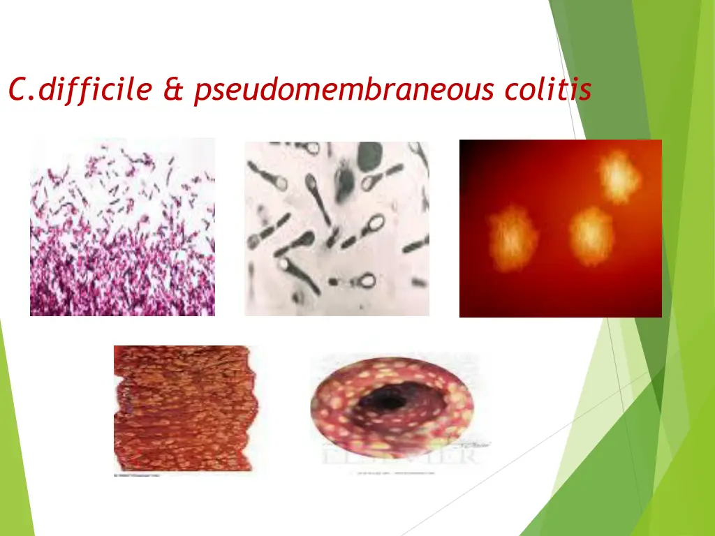 c difficile pseudomembraneous colitis