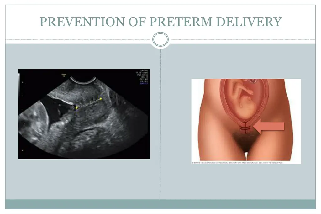 prevention of preterm delivery 1