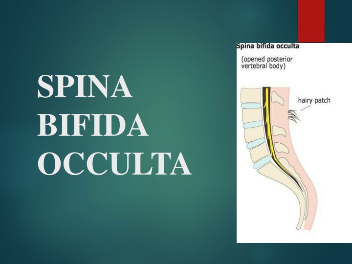 spina bifida occulta