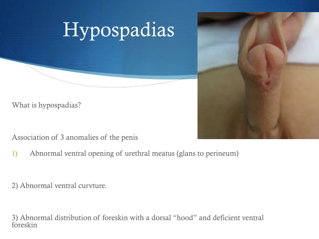 hypospadias 1