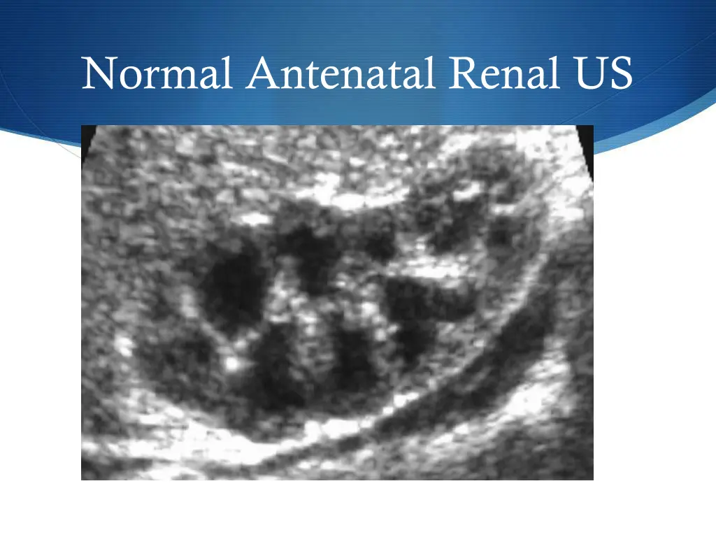 normal antenatal renal us