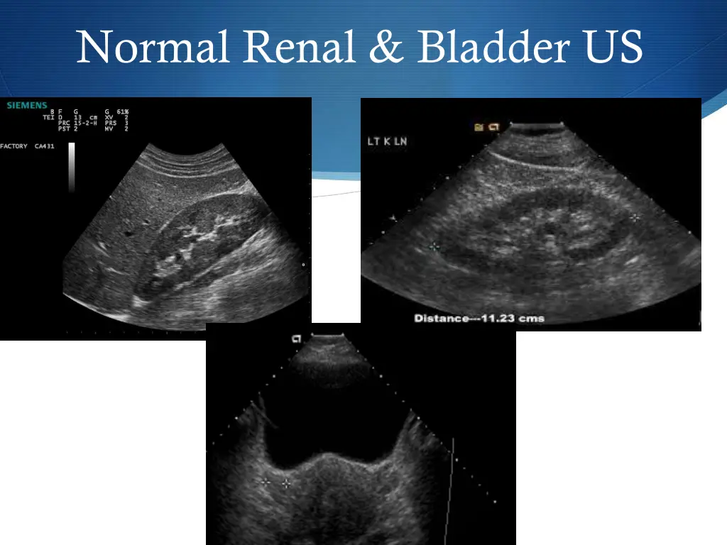 normal renal bladder us