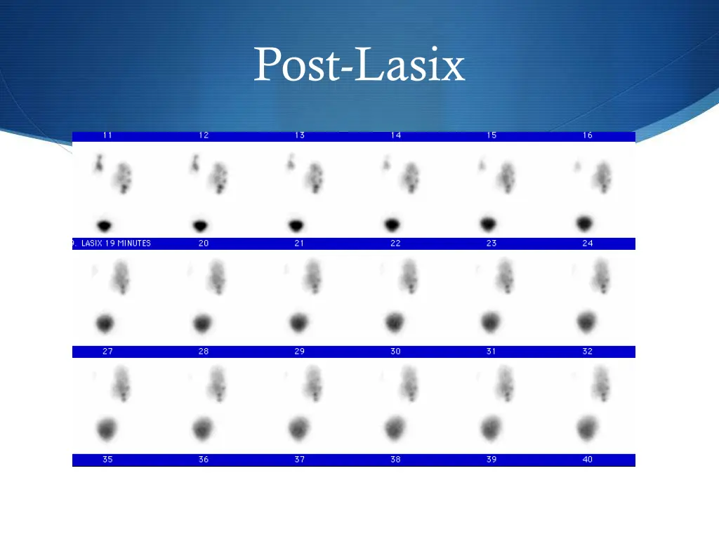 post lasix 1