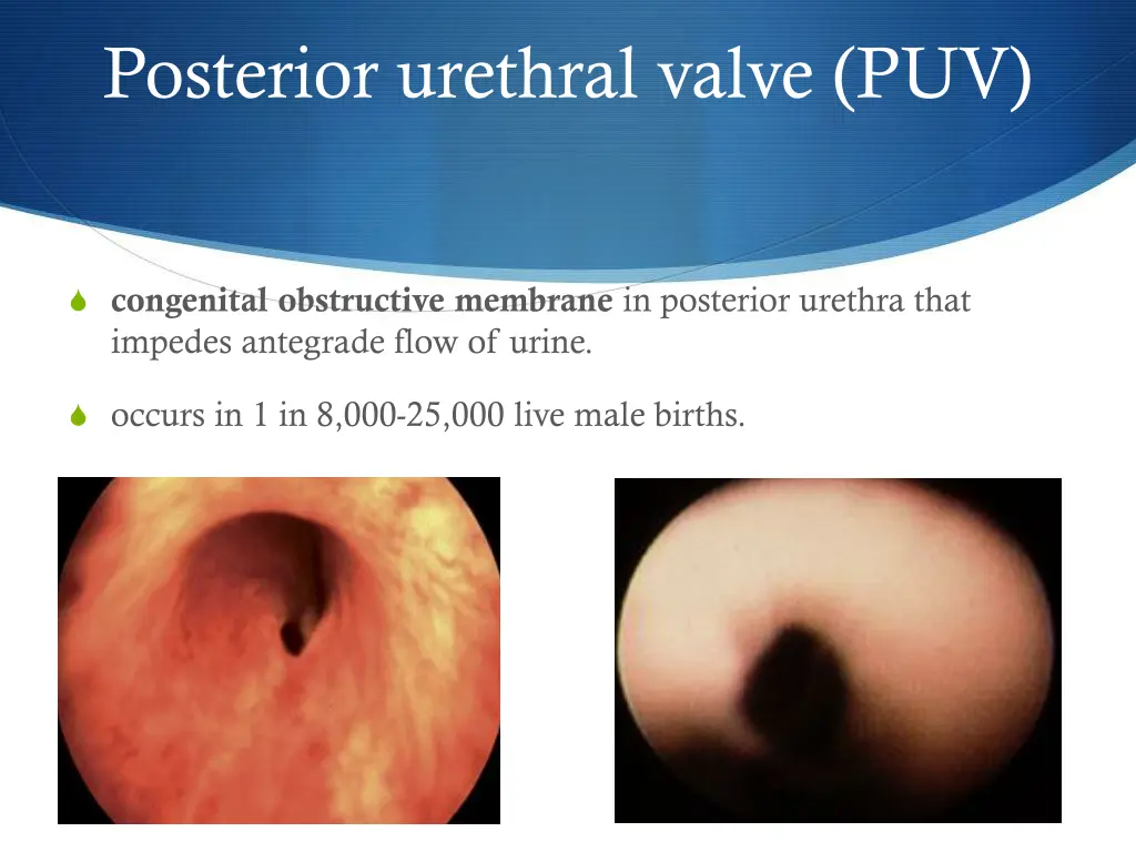 posterior urethral valve puv