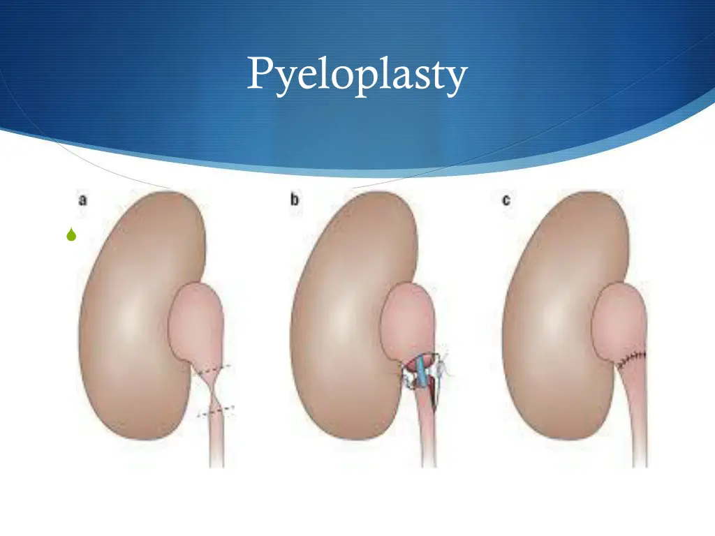 pyeloplasty