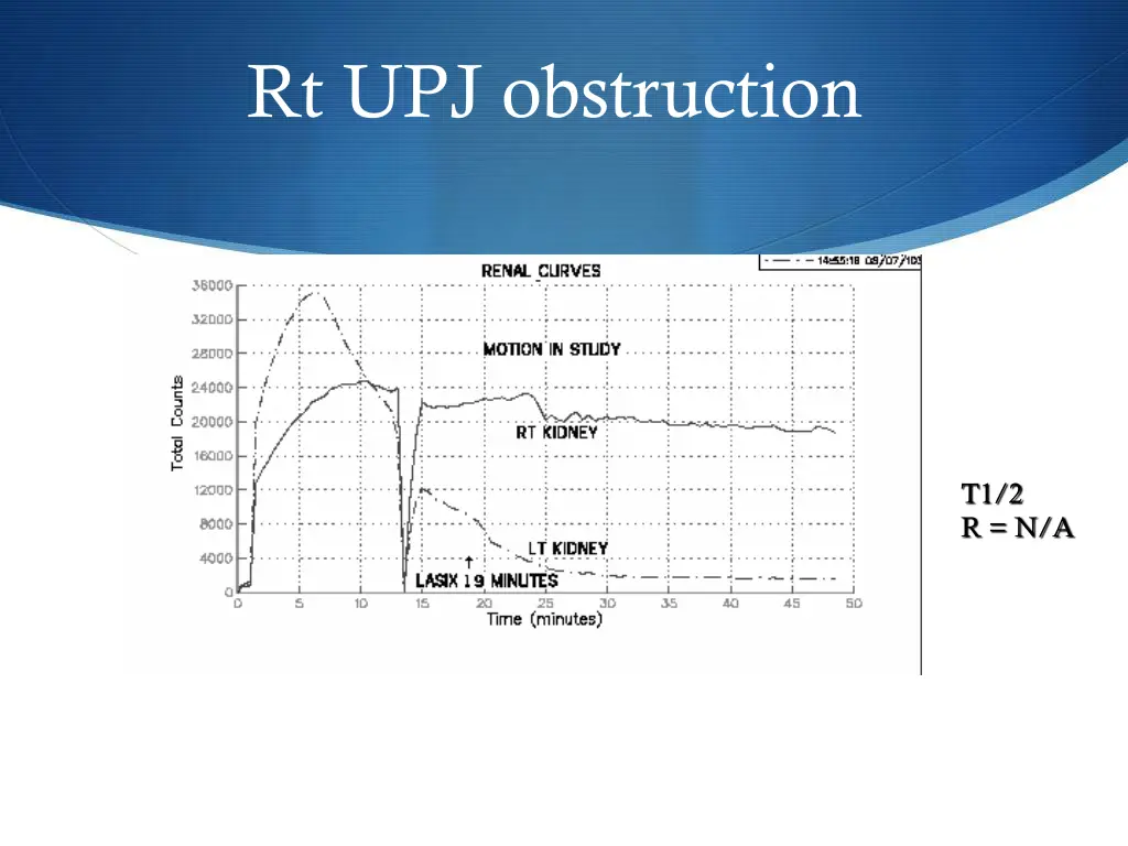 rt upj obstruction