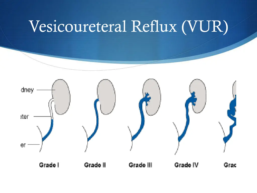 vesicoureteral reflux vur