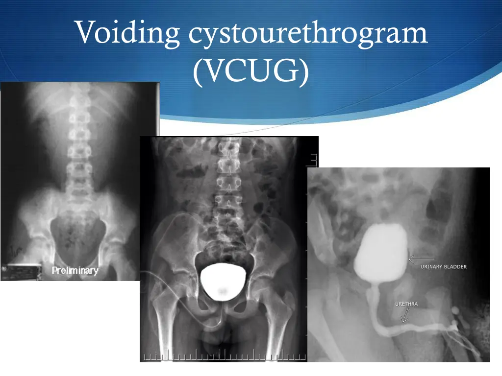 voiding cystourethrogram vcug