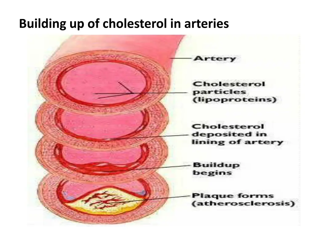 building up of cholesterol in arteries