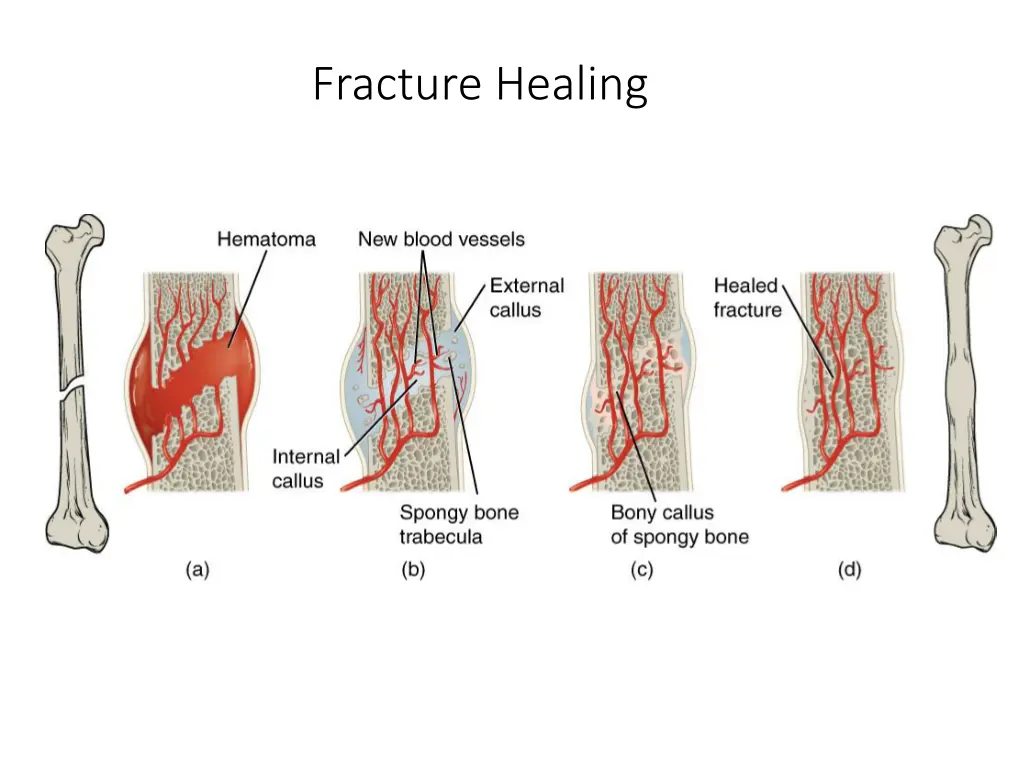 fracture healing