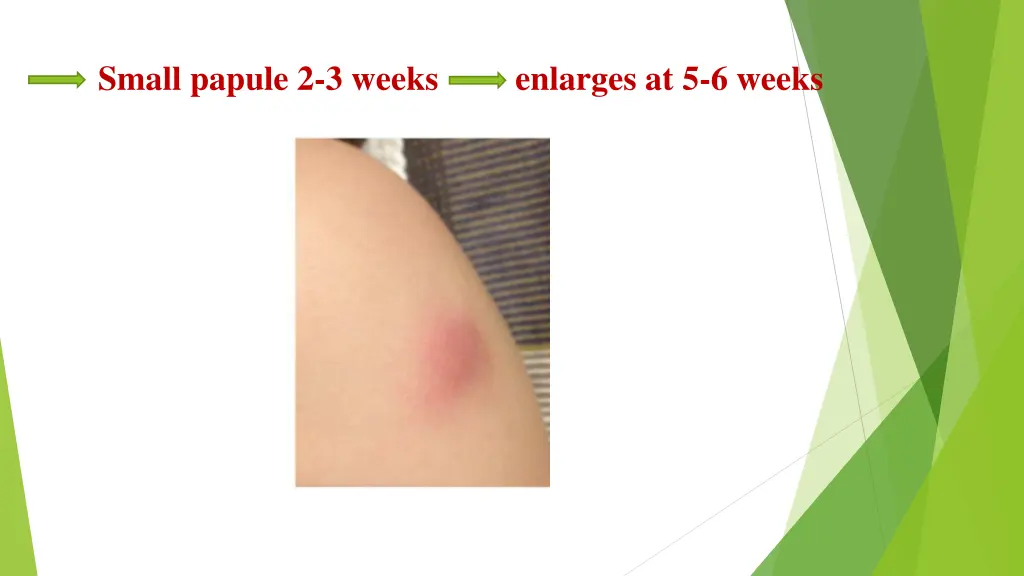 small papule 2 3 weeks enlarges at 5 6 weeks