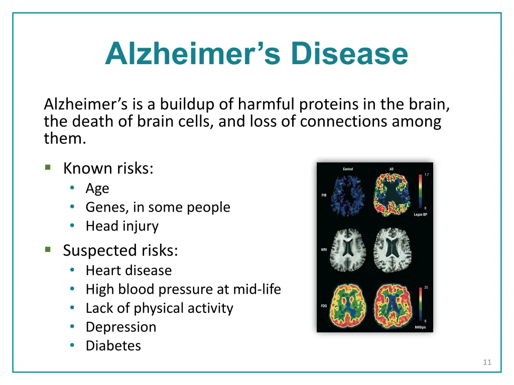 alzheimer s disease