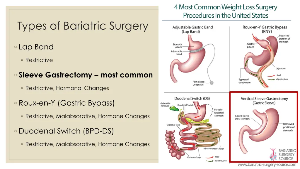 types of bariatric surgery