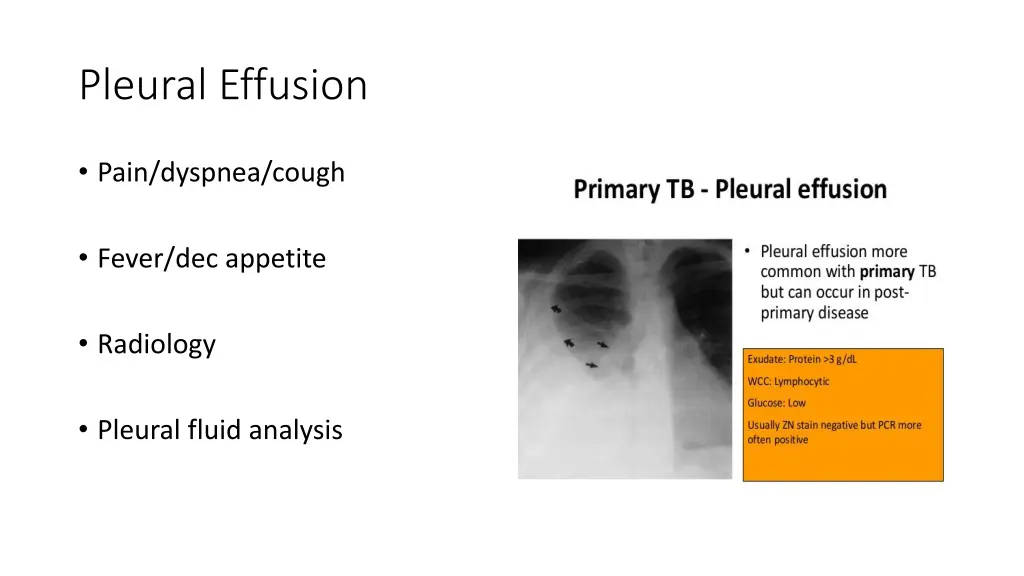 pleural effusion