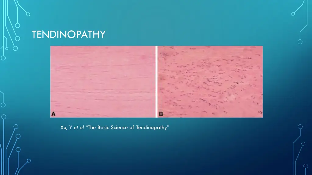 tendinopathy 1