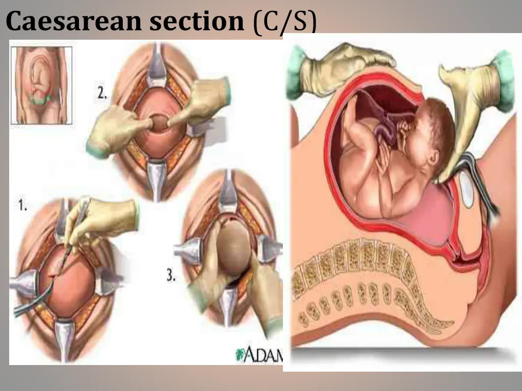 caesarean section c s