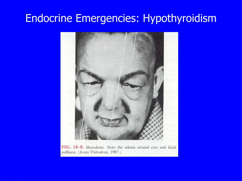 endocrine emergencies hypothyroidism 2