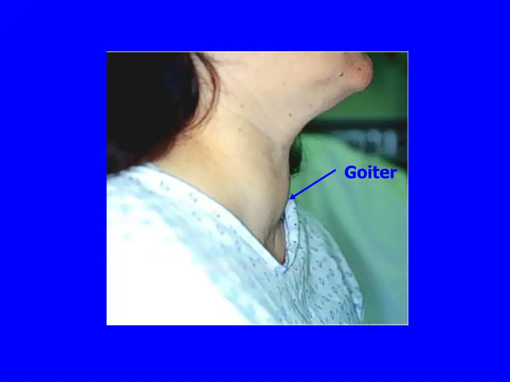 goiter