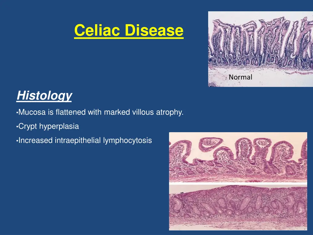 celiac disease