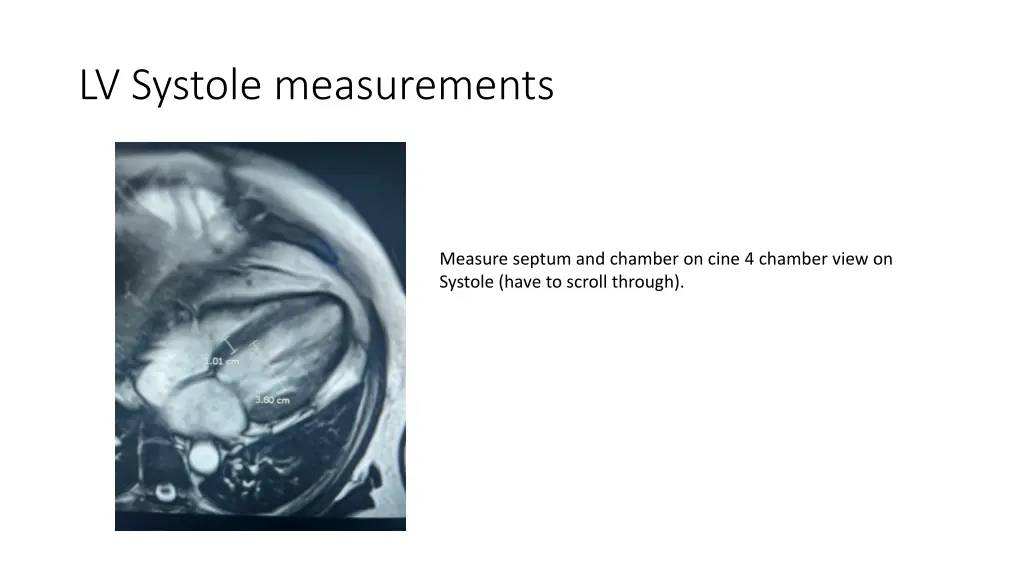 lv systole measurements