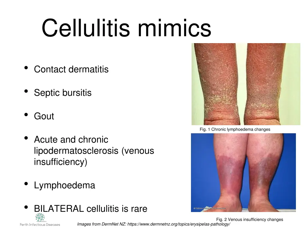 cellulitis mimics