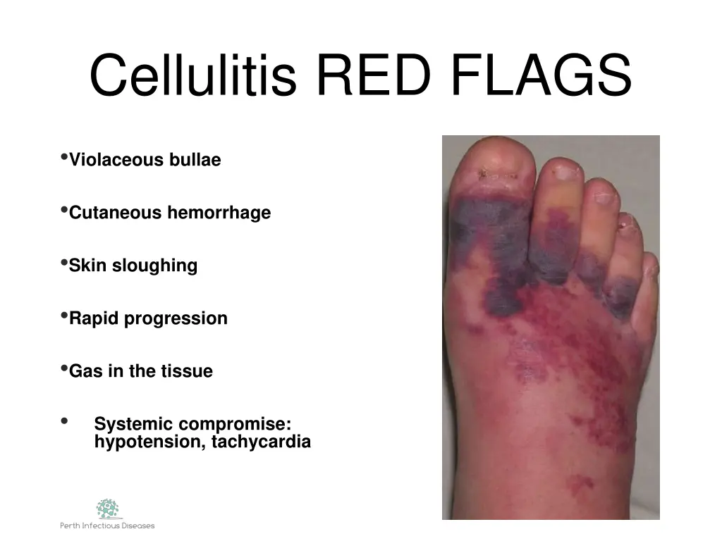 cellulitis red flags