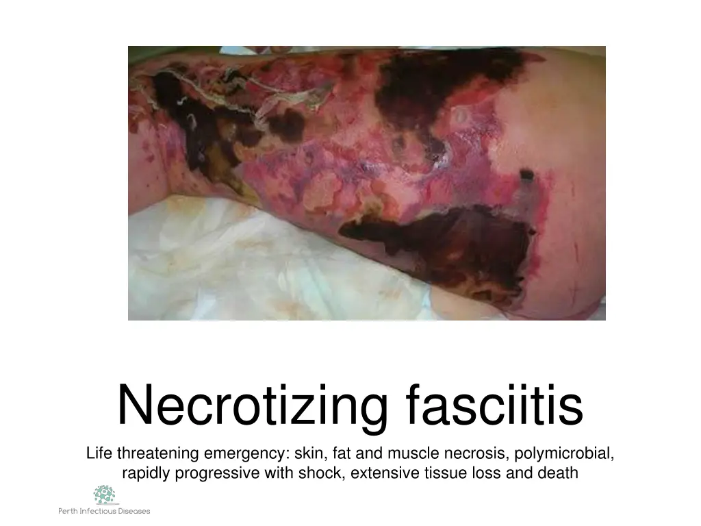 necrotizing fasciitis life threatening emergency