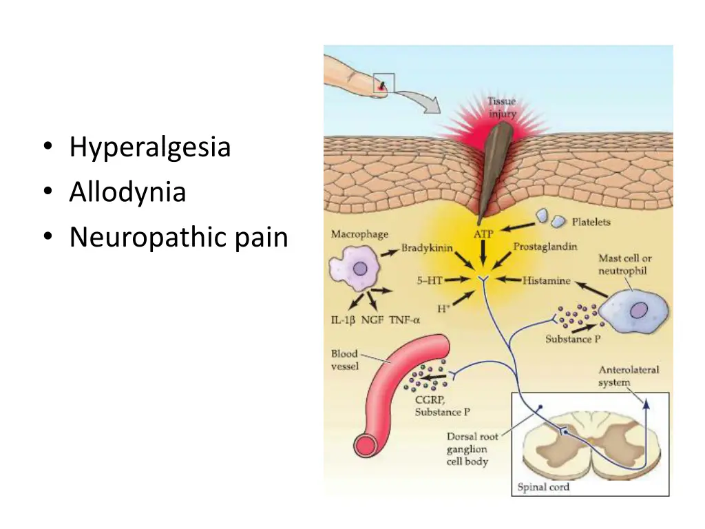 hyperalgesia allodynia neuropathic pain