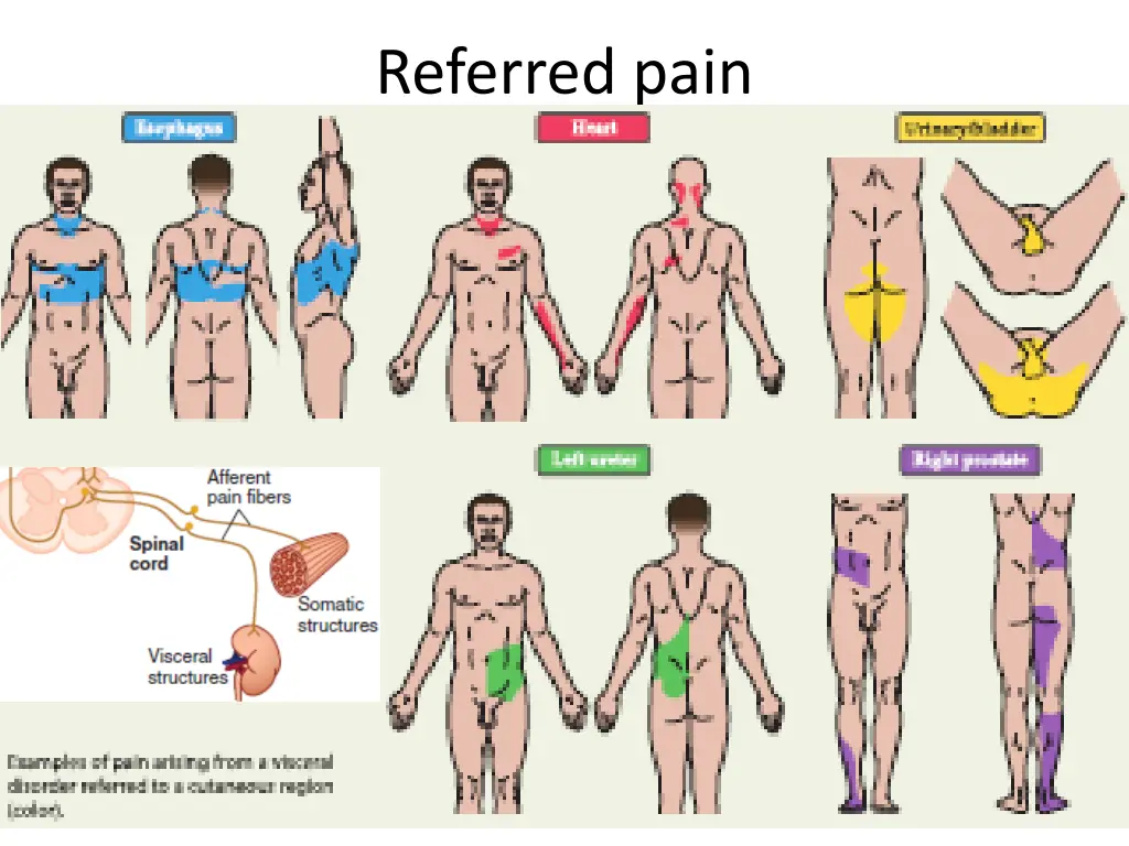 referred pain