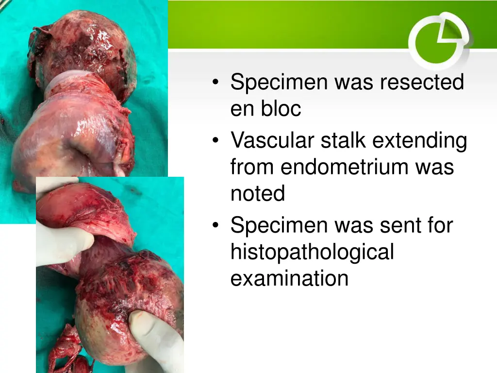 specimen was resected en bloc vascular stalk