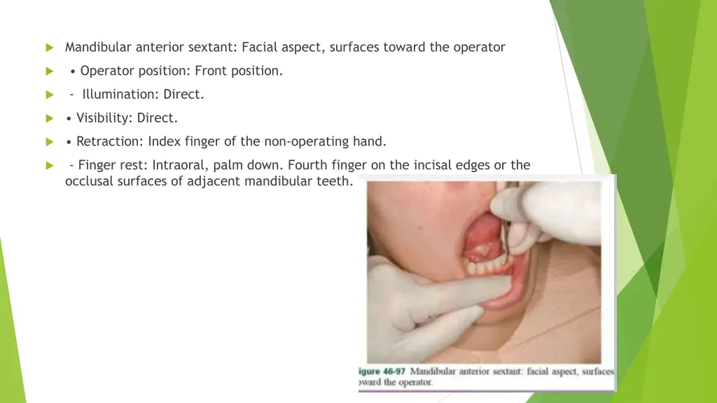 mandibular anterior sextant facial aspect