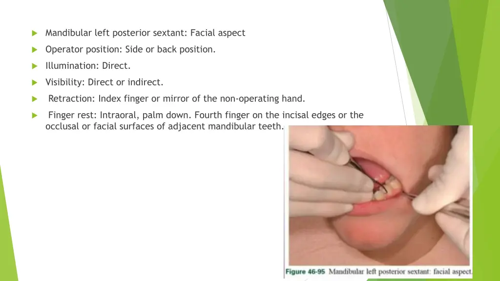 mandibular left posterior sextant facial aspect