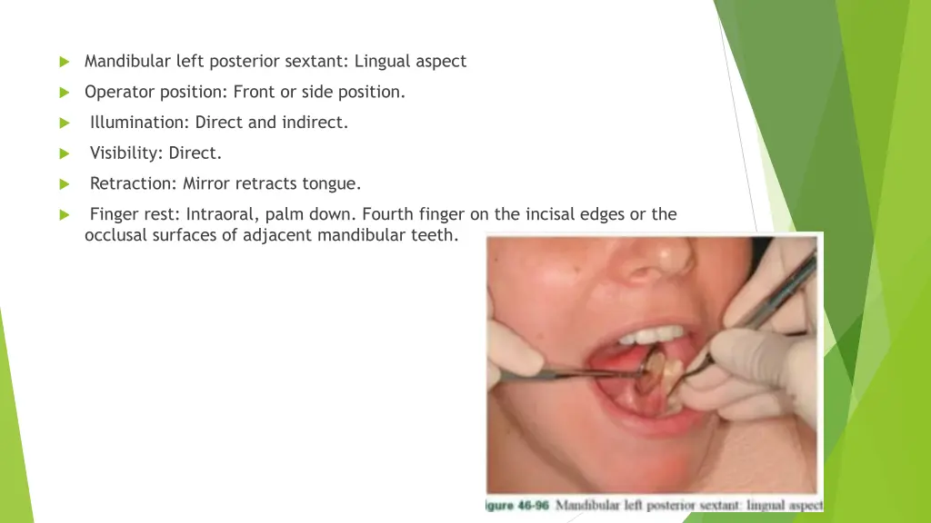 mandibular left posterior sextant lingual aspect