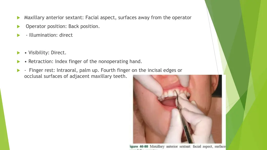 maxillary anterior sextant facial aspect surfaces