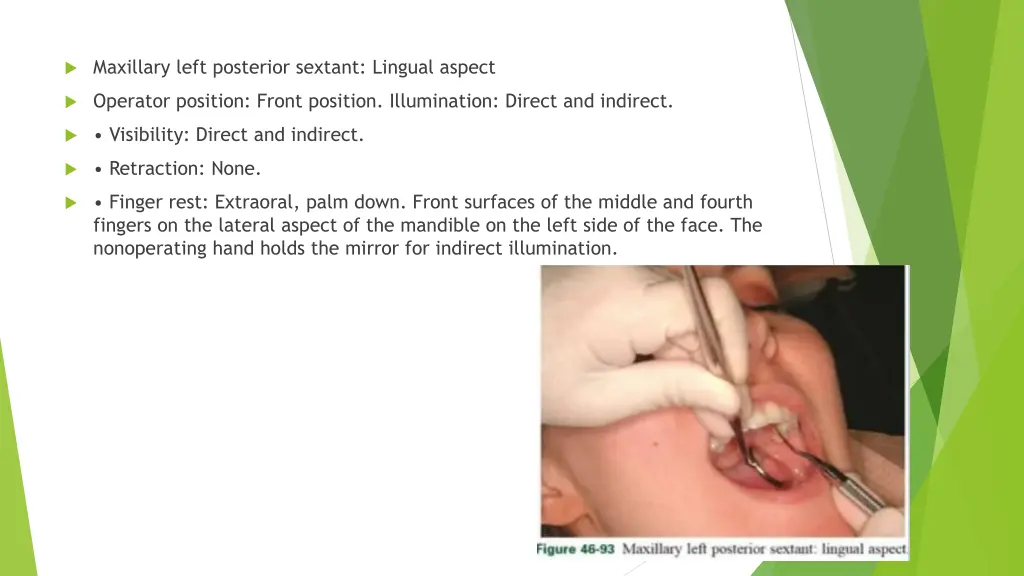 maxillary left posterior sextant lingual aspect 1