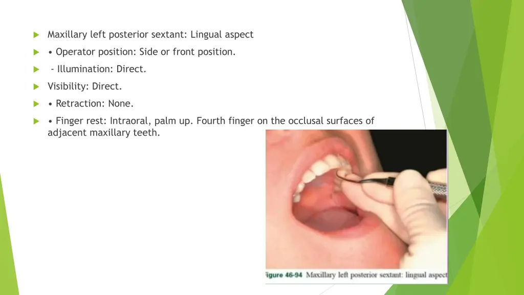 maxillary left posterior sextant lingual aspect 2