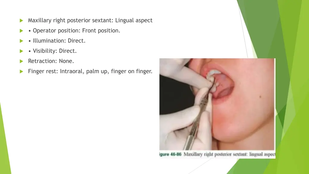 maxillary right posterior sextant lingual aspect 1